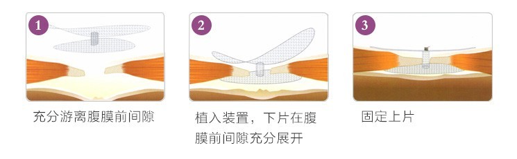 助展式膠膜前疝修補(bǔ)裝置