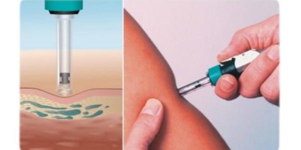 簡易玻璃注射器撤出歷史的舞臺